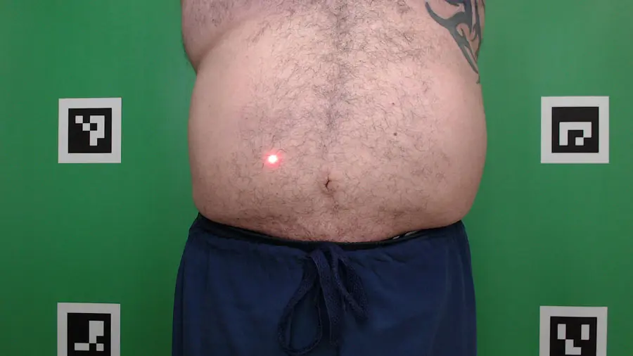 Before CellSound: Nuvell Clinics patient abdomen before treatment
