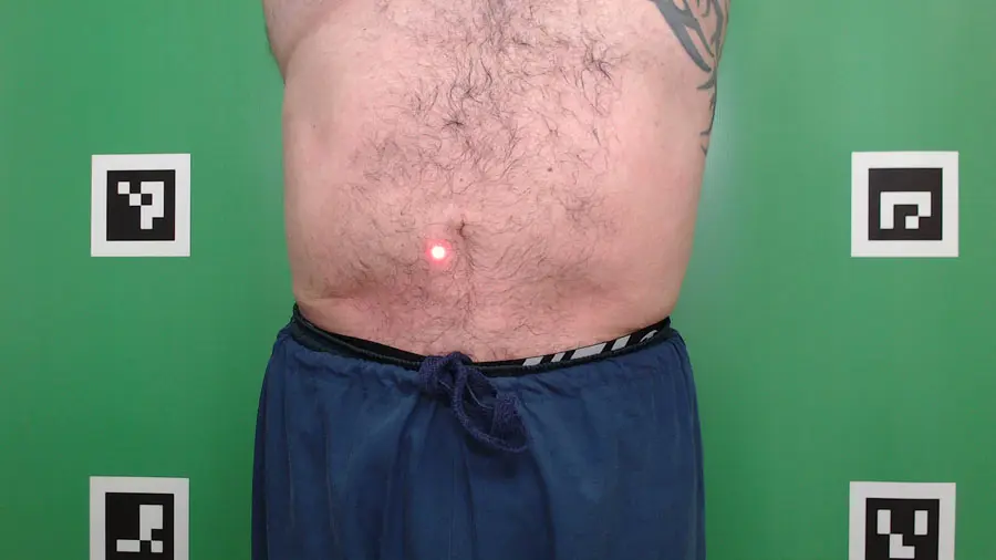 After CellSound: same Nuvell Clinics patient abdomen after treatment